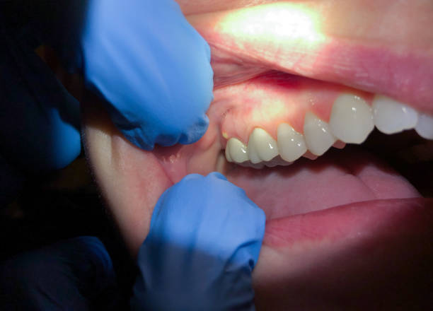 Best Emergency Dental Care for Broken or Chipped Teeth in Dunn, NC
